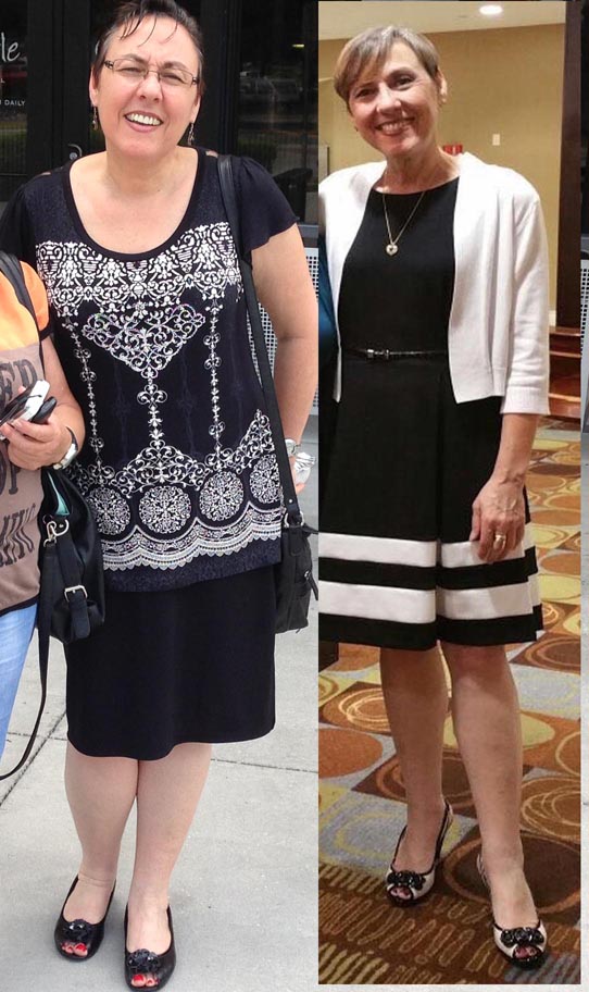 Before and after stroke on the keto diet